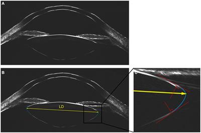 The relationships between lens diameter and ocular biometric parameters: an ultrasound biomicroscopy-based study